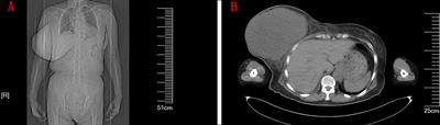 Severe Hypoglycemia Caused by a Giant Borderline Phyllodes Tumor of the Breast: A Case Report and Literature Review